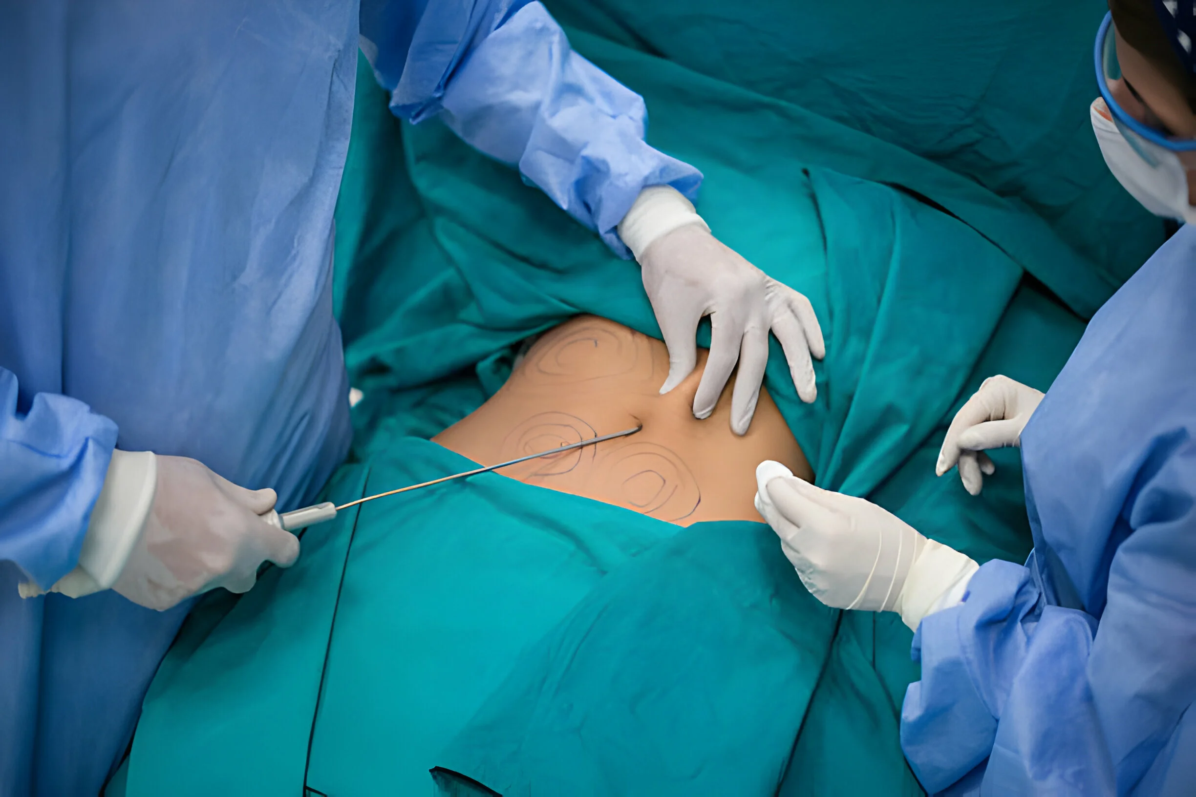 Liposuction in Islamabad