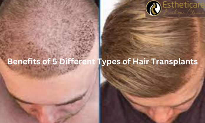 Benefits of 5 Different Types of Hair Transplants showcasing before and after results.