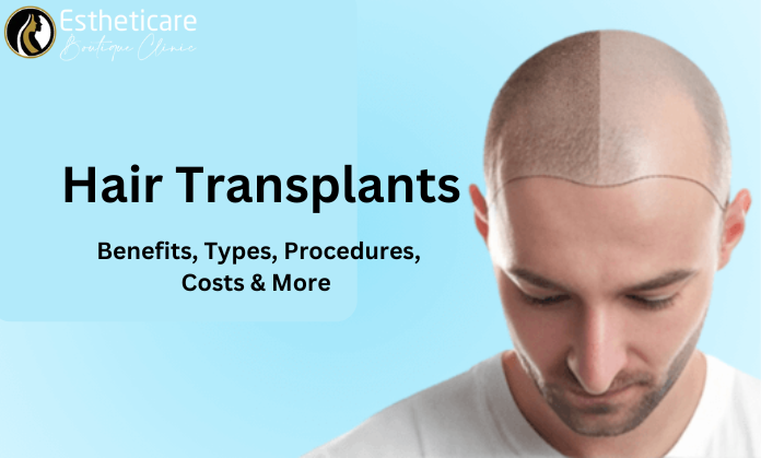 Hair Transplants Benefits, Types, Procedures, and Costs