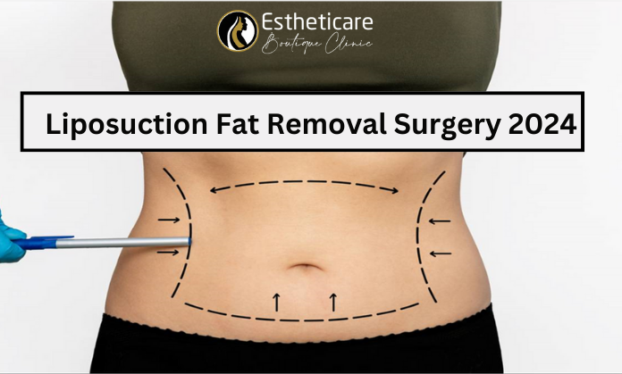 Liposuction surgery in Islamabad