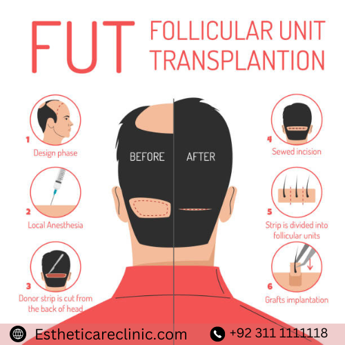 FUT hair transplant in Islamabad