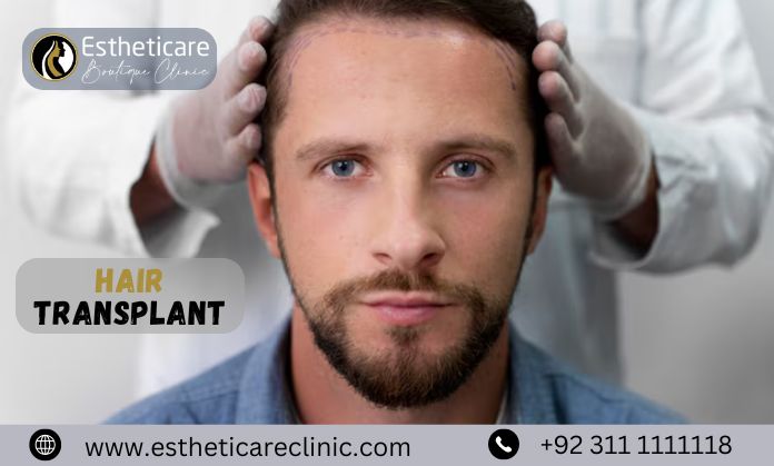 Hair Transplant Price in Pakistan: What You Need to Know Before Booking