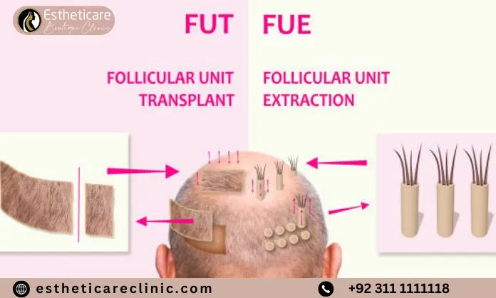 FUT and FUE Hair Transplant in Islamabad