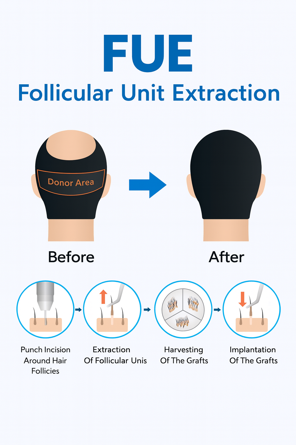 How to Decide Between FUT, FUE, and Robotic Hair Transplant for Your Hair loss treatment 3 FUE Hair Transplant