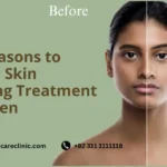 Top 5 Reasons to Consider Skin Whitening Treatment for Women