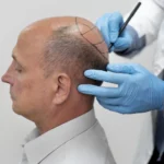 Is Hair Transplant Permanent? A Comprehensive Guide