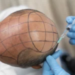 How Many Times Can You Have Hair Transplant Surgery?