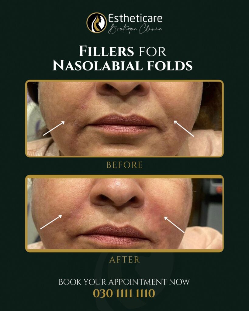 Before and After of Fillers for Nasolabial Folds by Estheticare
