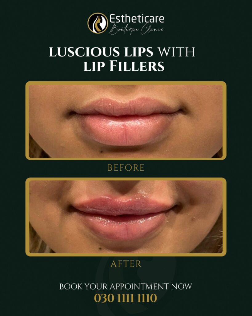 Before and After of Luscious Fillers with Lip Fillers in Islamabad