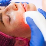 How Laser Therapy Can Delay Signs of Ageing