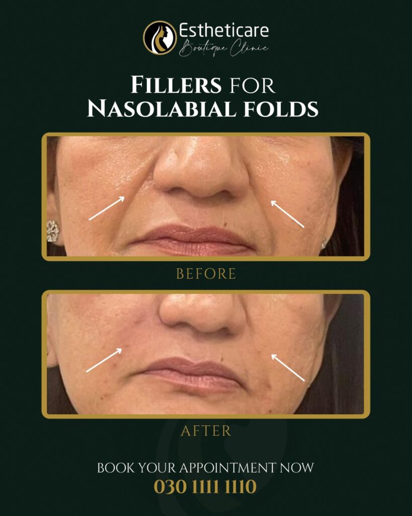 Before and After of Fillers for Nasolabial Folds - Fillers in Islamabad Pakistan