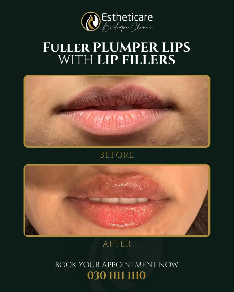 Before and After of Fuller Plumper Limps with Lip Fillers - Fillers in Islamabad by Expert Dermatologists