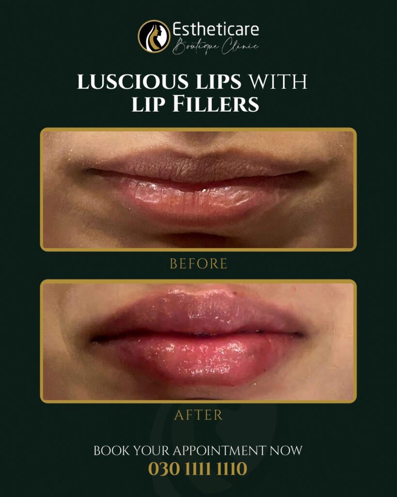Before and After of Luscious Fillers with Lip Fillers in Islamabad