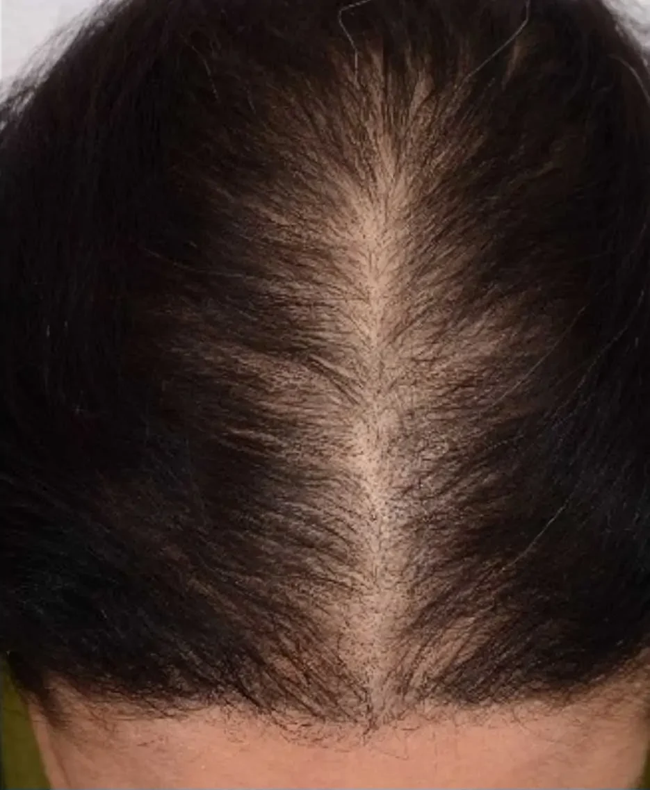 PRP For Hair Loss Before And After Photo Female 5 Treatments Platelet Rich Plasma in Springfield Missouri e1752152248839