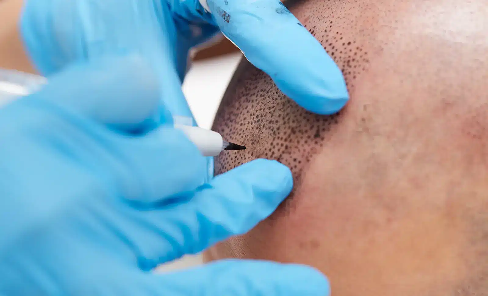 Scalp Micropigmentation