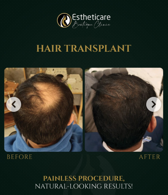 Before and after of hair Transplant