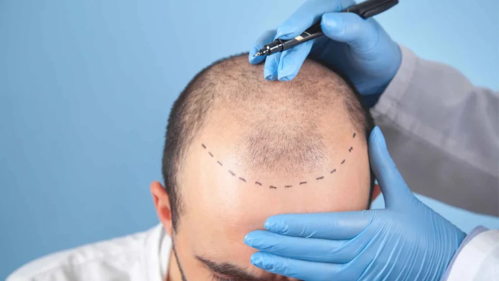 Scalp Micropigmentation