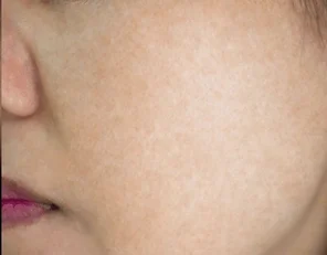 image before after spot melasma 600nw 1381949693 1 e1751962736224