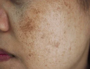 image before after spot melasma 600nw 1381949693 e1751962762813