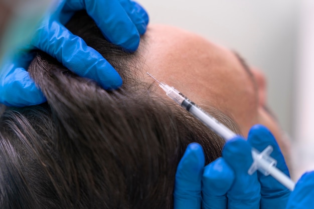 man getting hair loss treatment 23 21491527671