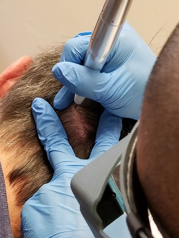 Scalp Micropigmentation