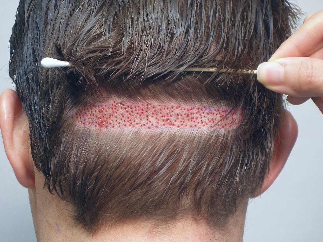 FUT Hair Transplant