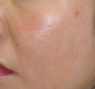 12 Asian skin Melasma treatment before after e1759526052476