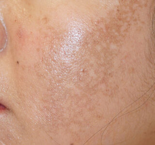 12 Asian skin Melasma treatment before after e1759526134635