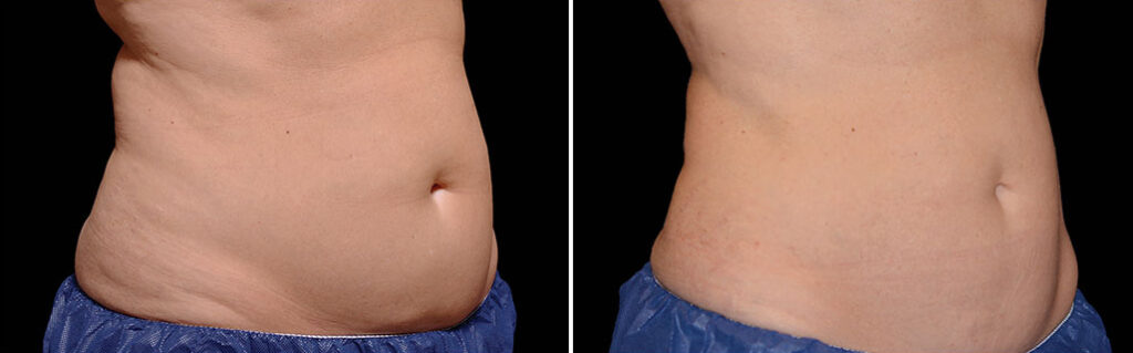 Fat Reduction Treatment