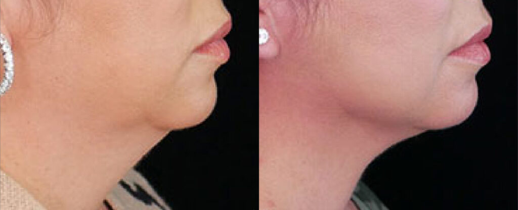 Fat Reduction Treatment