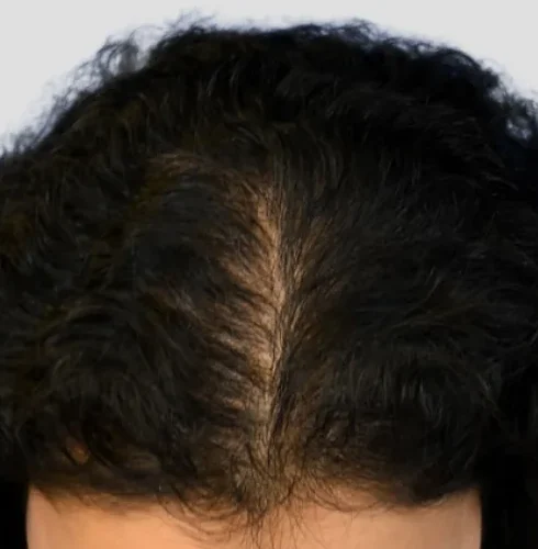 Mesotherapy Before and After female Hair Loss treatment 2 e1759525198943
