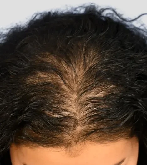 Mesotherapy Before and After female Hair Loss treatment 2 e1759525272192