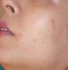 Mesotherapy for Acne before and after Treatment e1759524832112