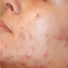 Mesotherapy for Acne before and after Treatment e1759524890333