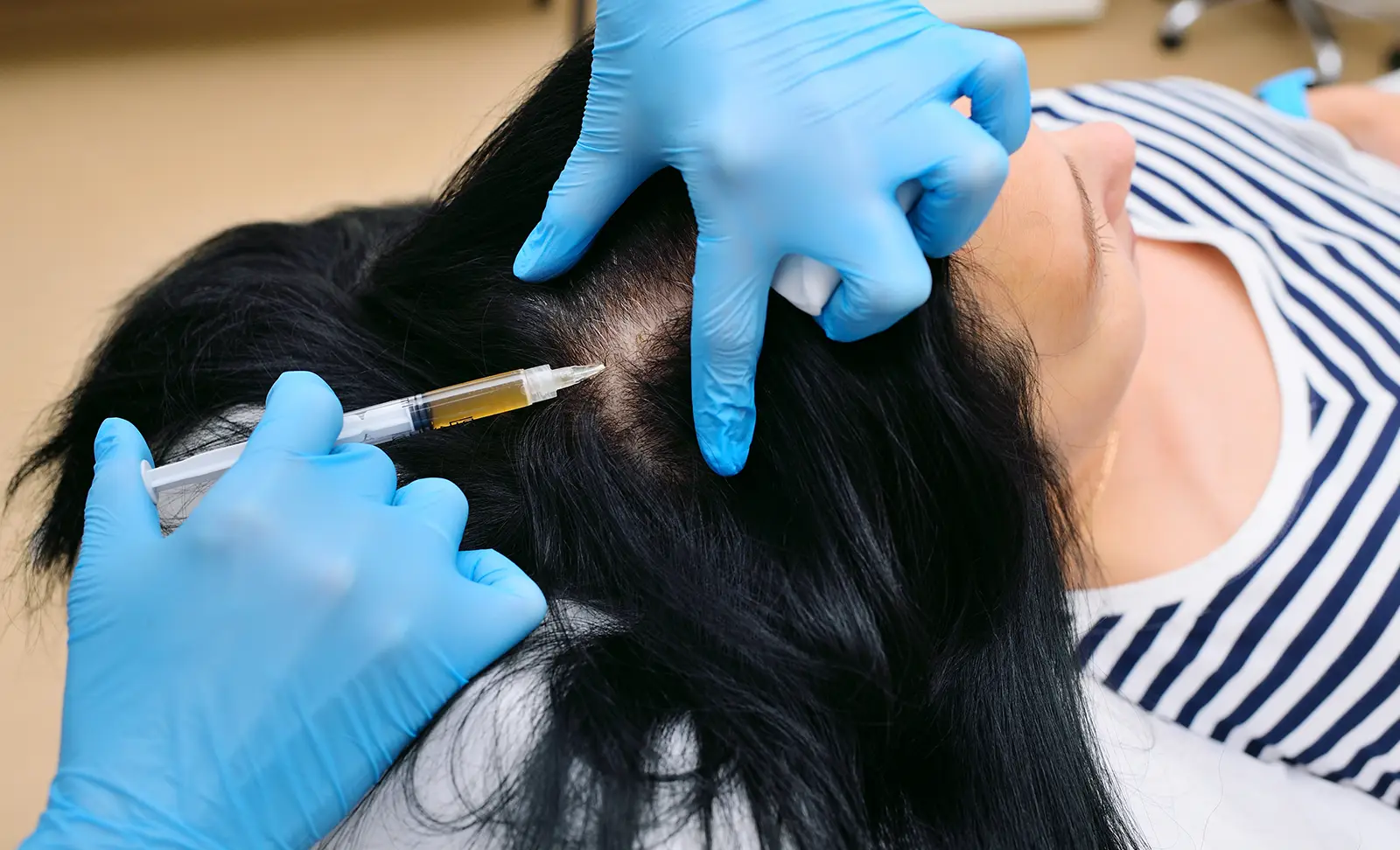 exosomes for hair loss