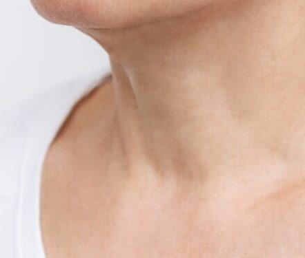 before and after mesotherapy neck e1759524999933