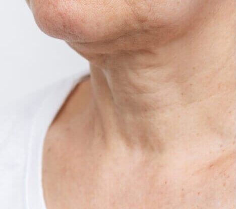 before and after mesotherapy neck e1759525129893