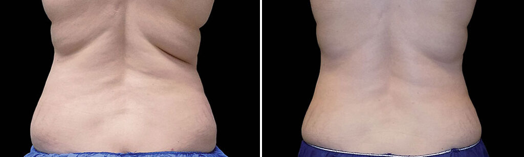 Fat Reduction Treatments Results