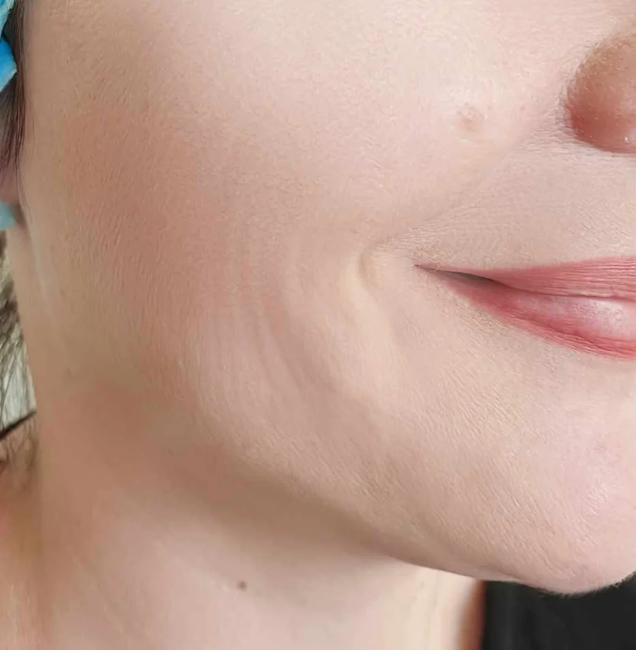 skin booster treatment e1760799853987