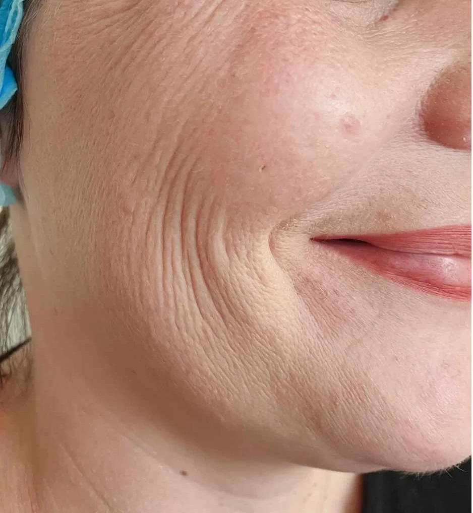 skin booster treatment e1760799904490