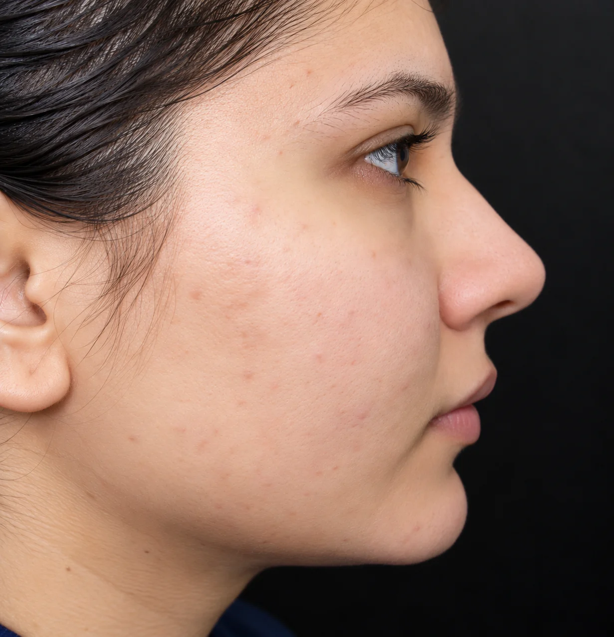 After Acne