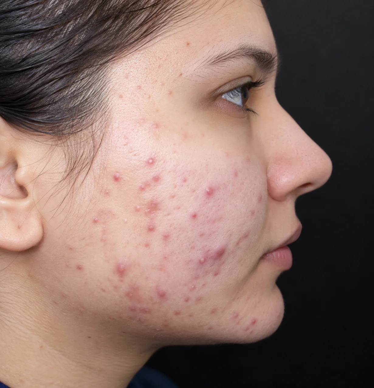 Before Acne
